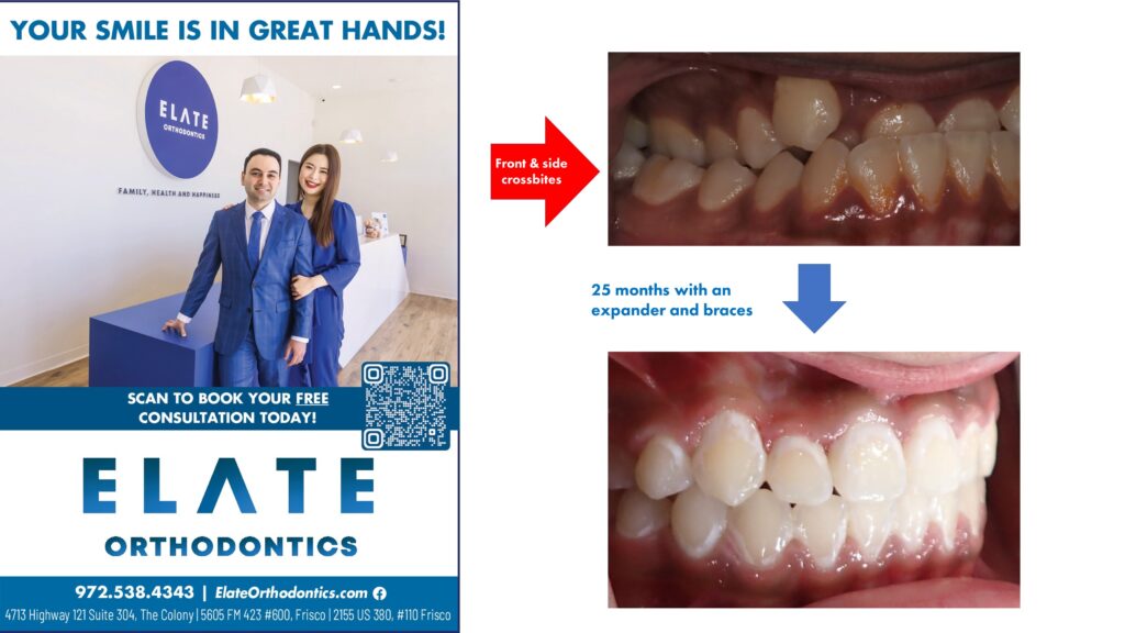 Before and after photos of adult orthodontic patient at Elate Orthodontics in Frisco, TX, showing improved arch width and smile alignment after using a palate expander.
